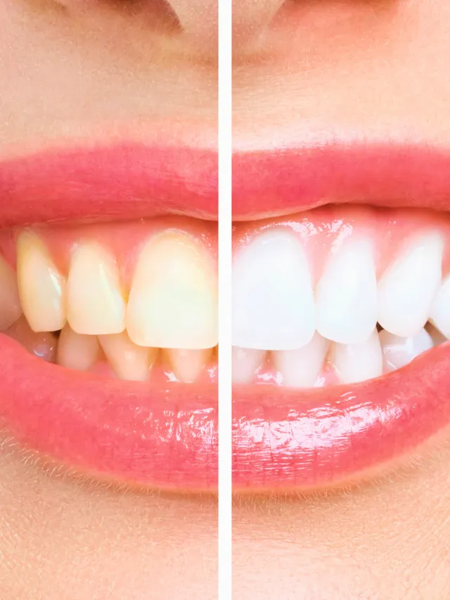 9 Natural Remedies For Teeth Whitening